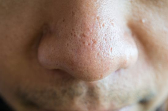 How to Remove Pimple Scars Naturally and Boost Skin Healing