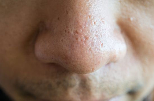 How to Remove Pimple Scars Naturally and Boost Skin Healing