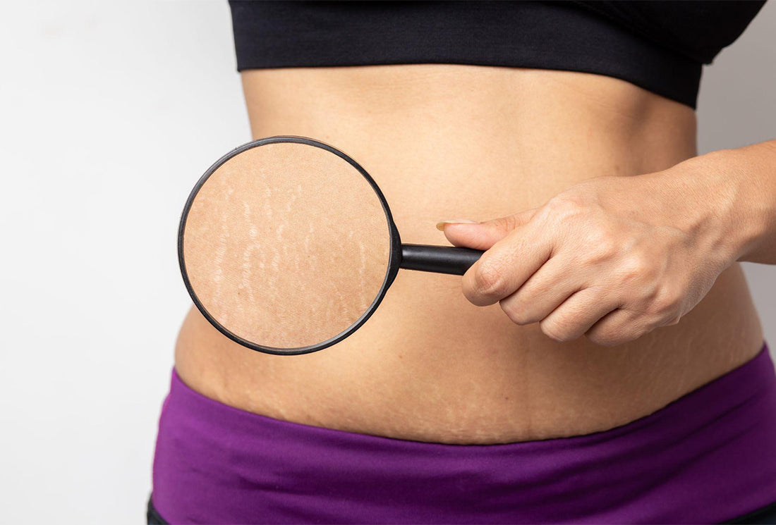 Red Stretch Marks on Stomach: Causes, Treatment, and How to Fade Them