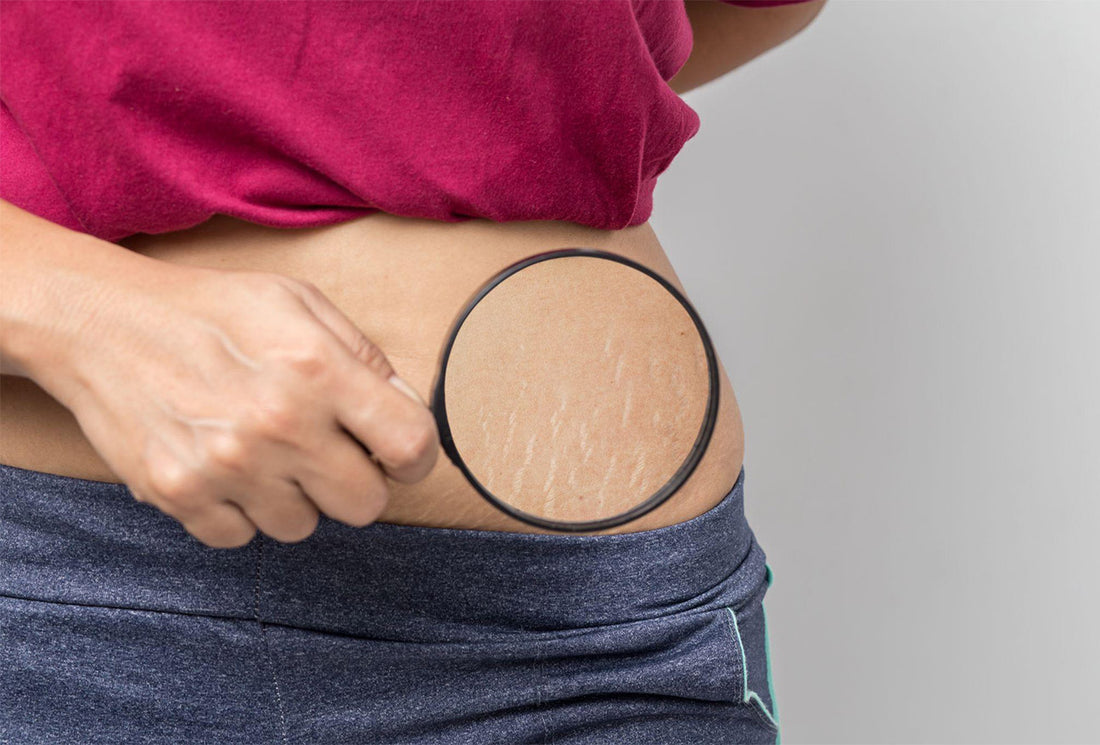 Pregnancy Stretch Marks: The Best Way to Prevent and Treat Them
