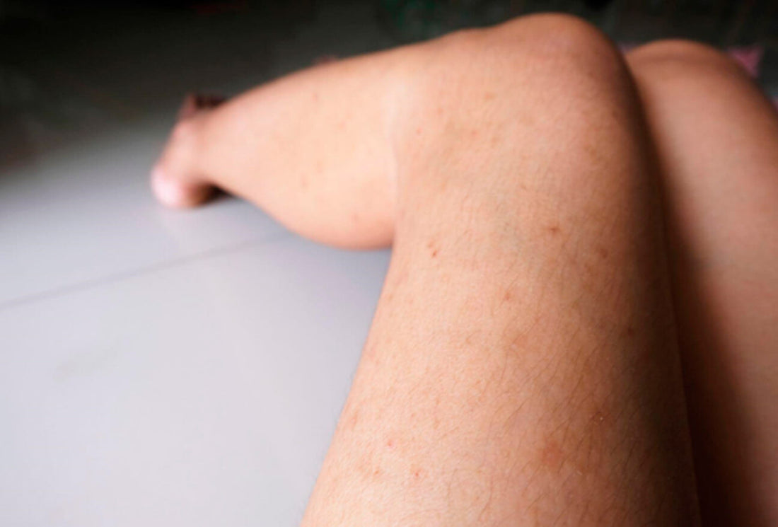 Top Treatments to Help You Get Rid of Dark Marks on Legs Fast