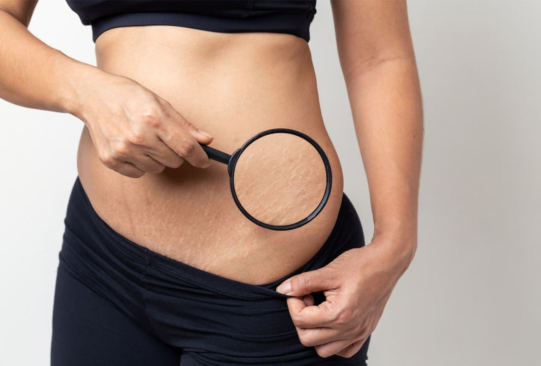 Understanding the Different Types of Stretch Marks