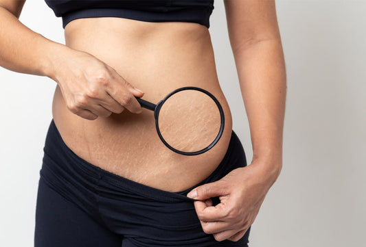 Understanding the Different Types of Stretch Marks
