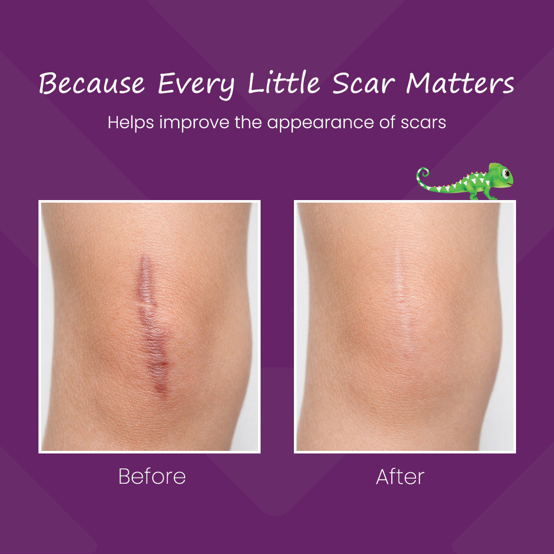 Mederma Scar Gel for Kids