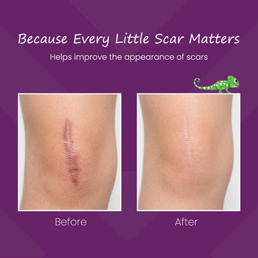 Mederma Scar Gel for Kids