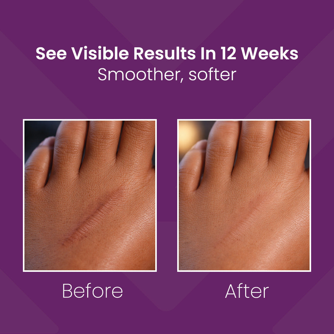 Mederma Scar Gel