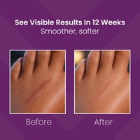 Mederma Scar Gel