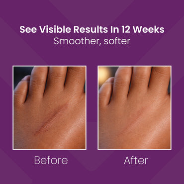 Mederma Scar Gel