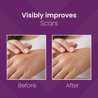 Mederma Advanced Plus Scar Gel