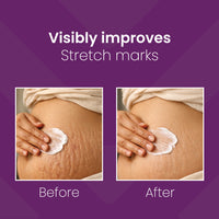 Mederma Stretch Marks Therapy