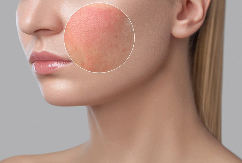 Effective Methods to Remove Pigmentation from Face and Achieve Even Skin Tone