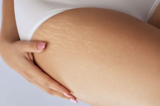 Say Goodbye to Stretch Marks on Butt: Top Treatments and Prevention Tips