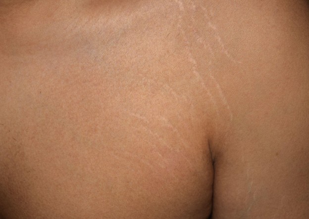 Are Stretch Marks on Shoulders Normal? Here’s What You Need to Know