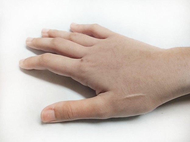 How to Remove Cut Marks from the Hand