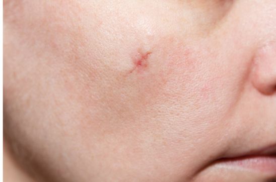 Scar on woman's face