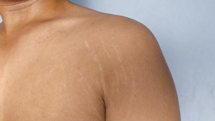 How to Treat Stretch Marks on Armpits: Causes, Treatments & Prevention
