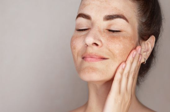 Woman with facial pigmentation and freckles gently touching her skin