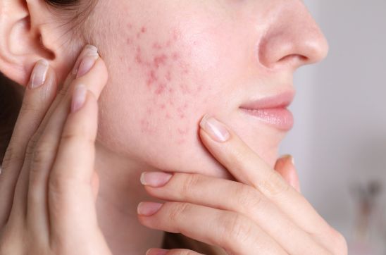Women with Acne Scars