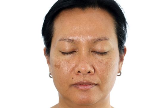 Melasma on face of a woman