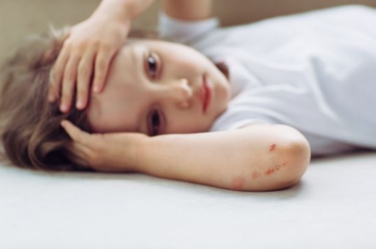 Scar on child's hand