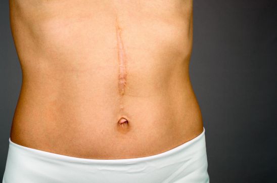 Surgery Scar on the abdomen of young woman