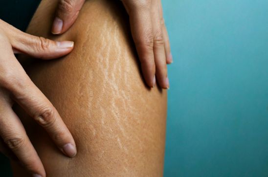 White stretch marks on thigh
