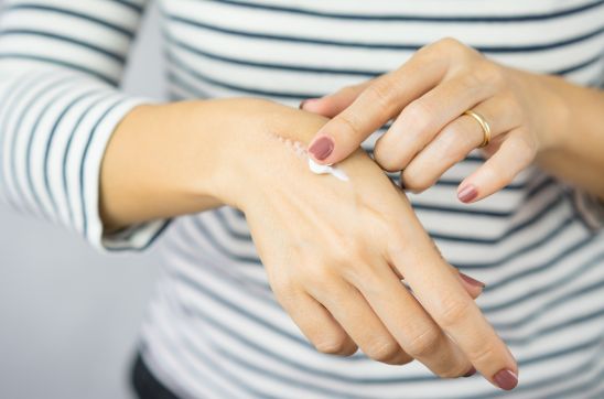 Women applying scar cream
