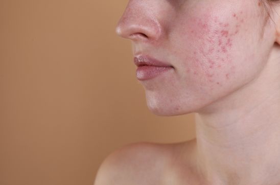 Women with acne and acne scars on her face