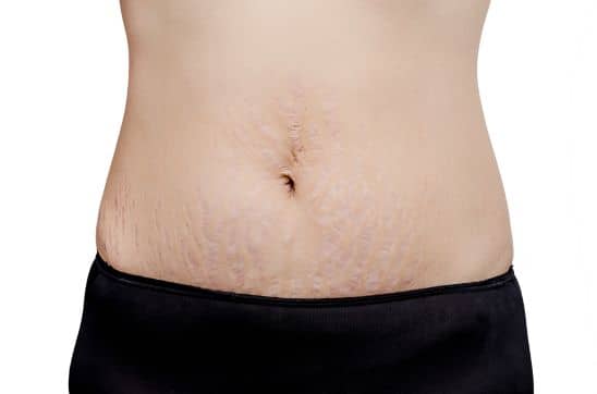 belly stretch marks on a woman