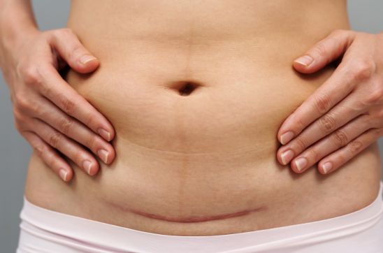 close up belly of woman with a c-section scar