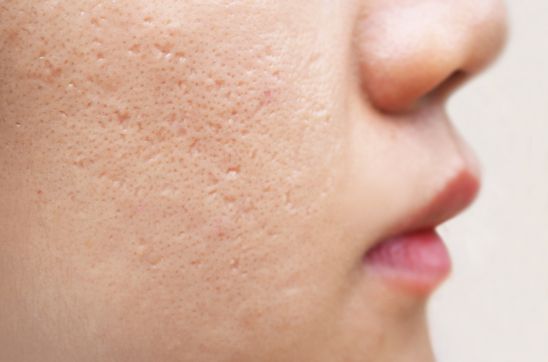 icepick scars acne on cheek on face in women
