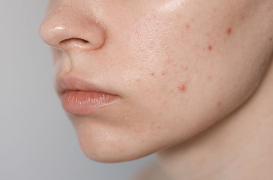 The Ultimate Acne Skincare Routine: Steps, Tips, and Products for Clear Skin