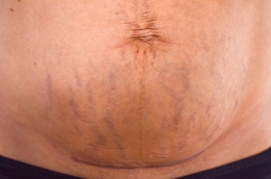 Purple Stretch Marks