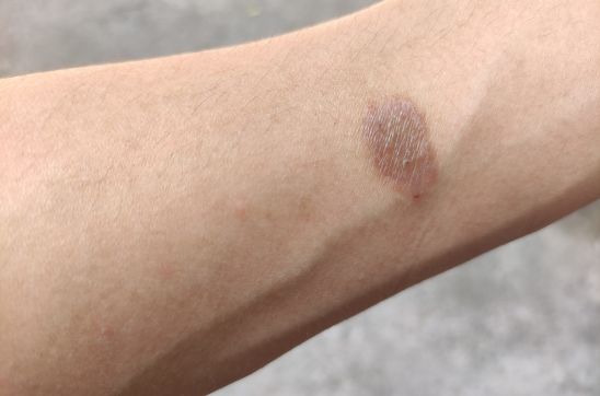 How to Treat and Remove Ringworm Scars: A Complete Guide