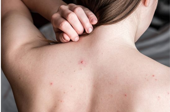 How to Remove Back Acne Scars: Effective Treatment & Tips for Clear Skin