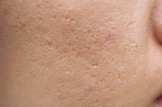 Depressed Acne Scars