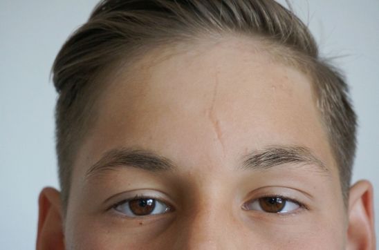 Scar on Forehead: Causes, Treatments & Prevention