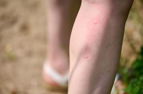Mosquito Bite Scars: How to Get Rid of Them Effectively