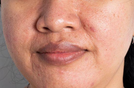 Understanding Pockmarks on the Face: Causes, Treatment, and Prevention