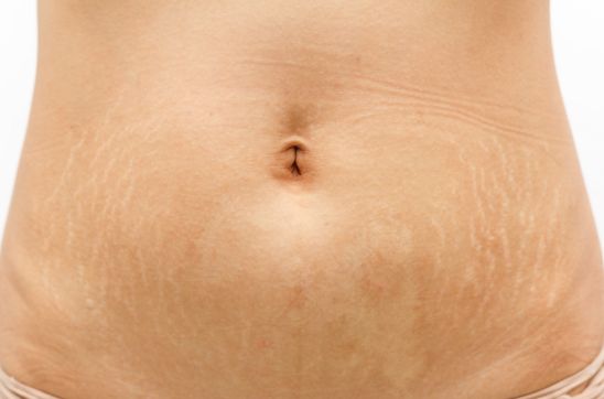 stretch marks after pregnancy