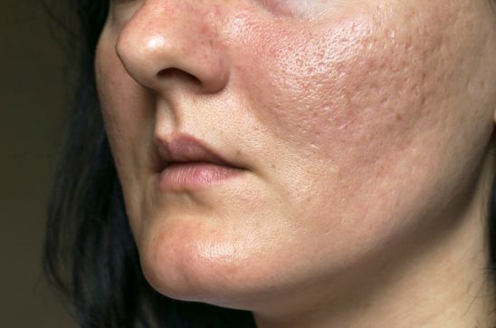 Types of Scars on Face: Causes, Identification & Treatments
