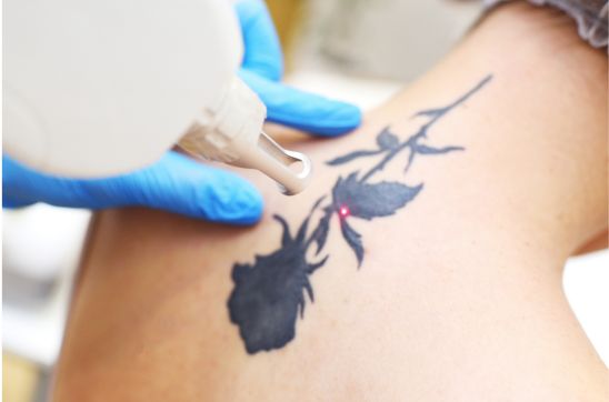Does Tattoo Removal Leave a Scar? What You Should Know About Scarring