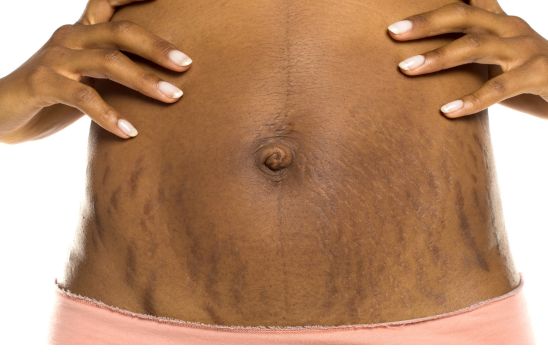 Black Stretch Marks: Causes, Meaning & How to Remove Them