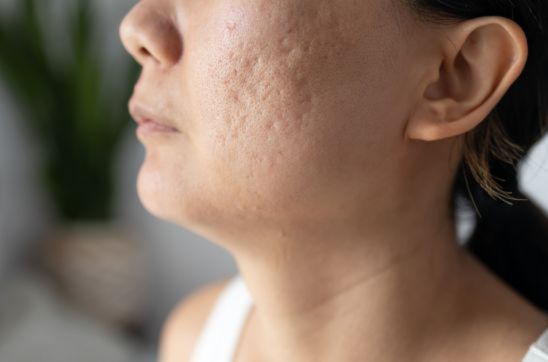 Understanding Depressed Acne Scars: Causes, Treatment, and Prevention