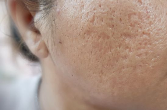 How to Remove Holes from the Face Permanently: Tips & Treatments