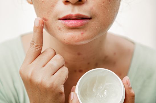 How to Remove Burn Marks from Face Effectively