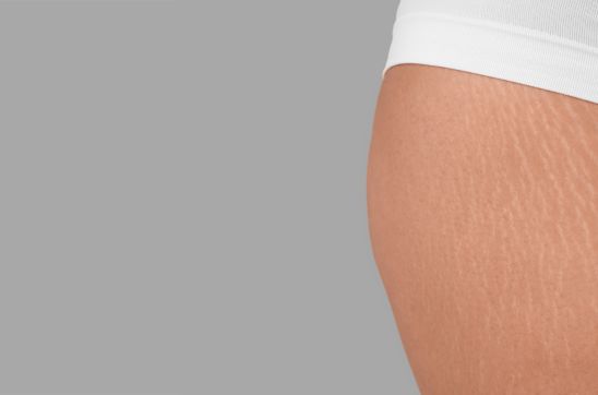 Inner Thigh Stretch Marks: Causes, Types & Removal Methods
