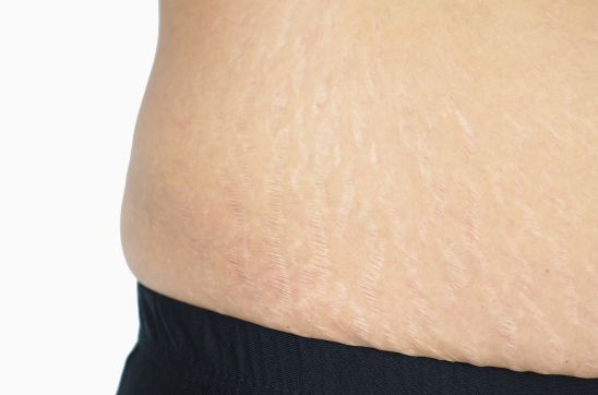 How to Remove Stretch Marks After Delivery: Effective Treatments & Tips