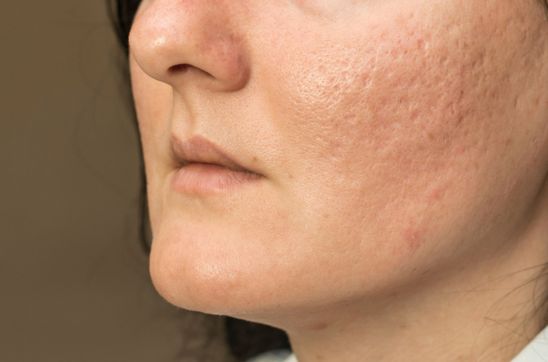 Understanding Pockmarks on the Face: Causes, Treatment, and Prevention