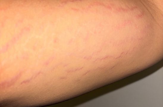 Stretch Marks on Hands: Causes, Types & Effective Ways to Reduce Them